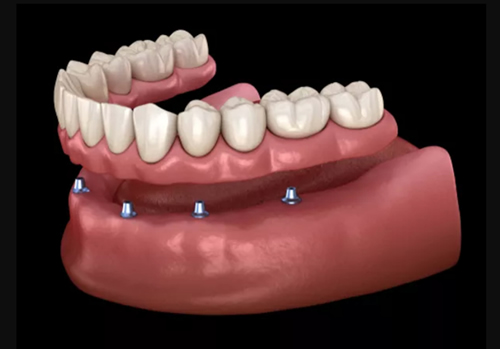 Implant Retained Dentures